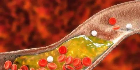 超聲造影告訴你：你的頸動脈斑塊“穩(wěn)定”嗎？