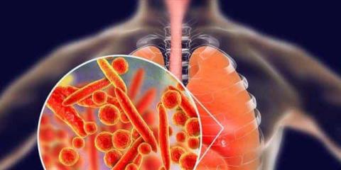 該如何應(yīng)對支原體肺炎？