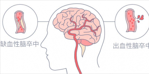 牢記兩大口訣，盡早識(shí)別急性腦血管疾病——“腦卒中”
