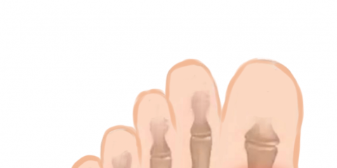 避雷！這六大痛風(fēng)的誤區(qū)別再犯了！